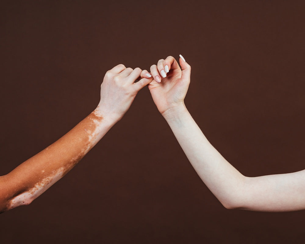 Is Vitiligo Contagious?