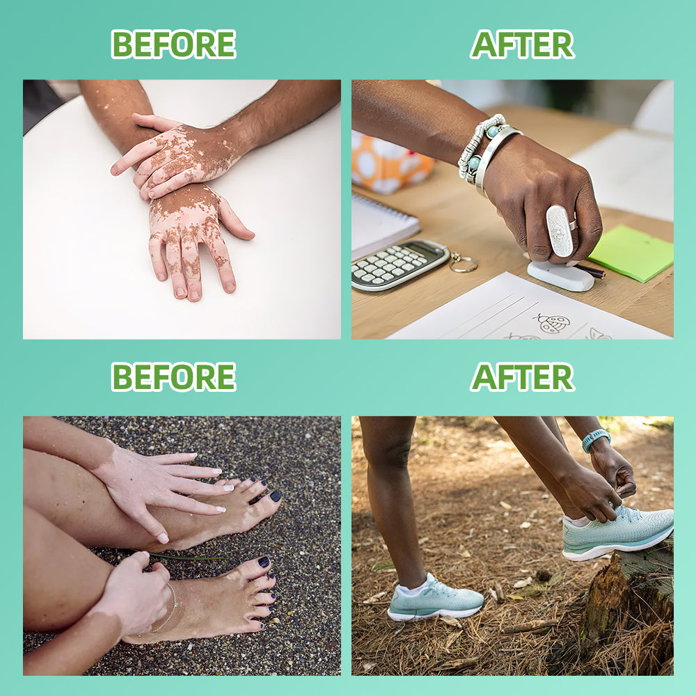 311nm UVB light therapy treatment for psoriasis vitiligo