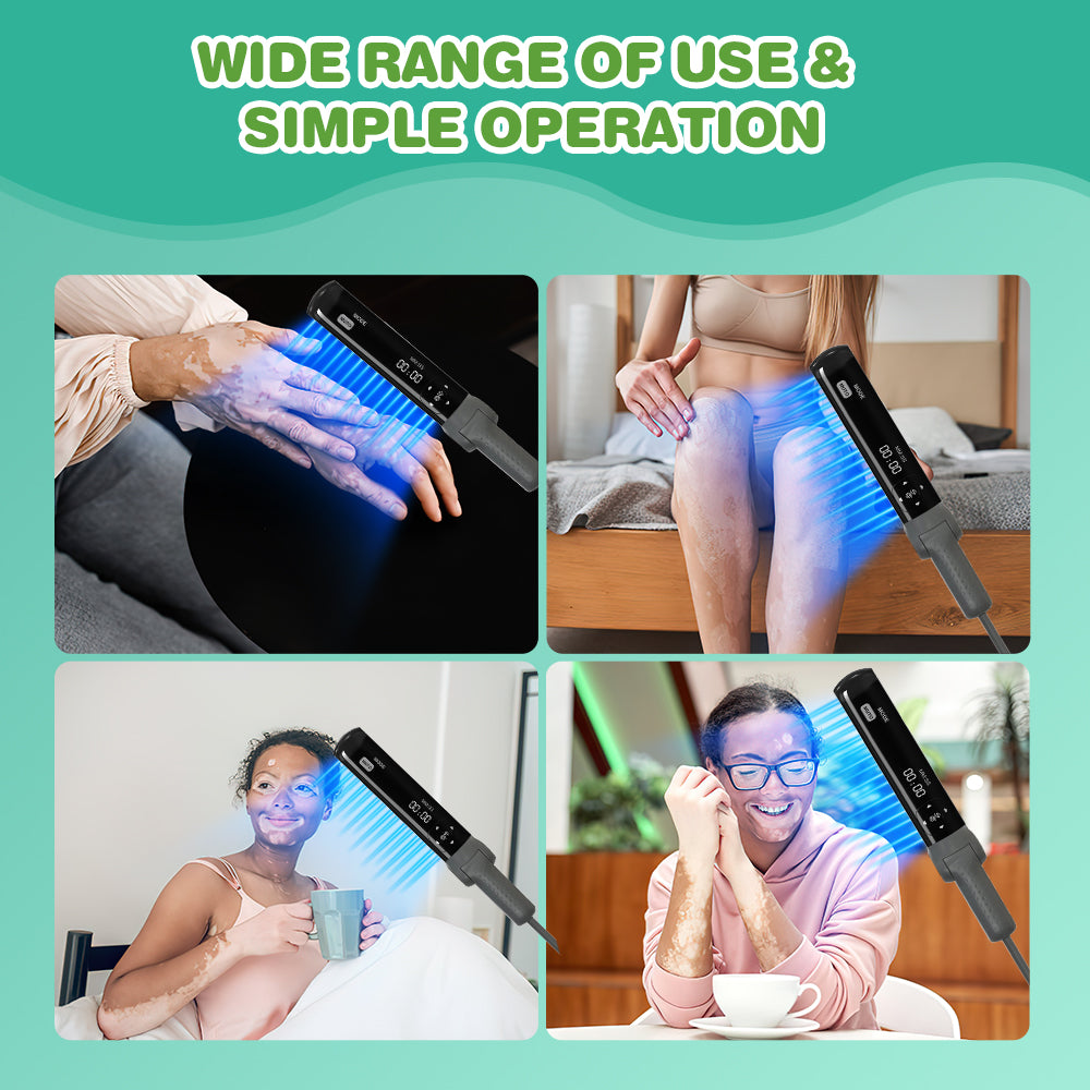311nm UVB light therapy treatment for psoriasis vitiligo