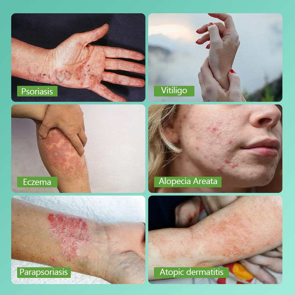 311nm UVB light therapy treatment for psoriasis vitiligo