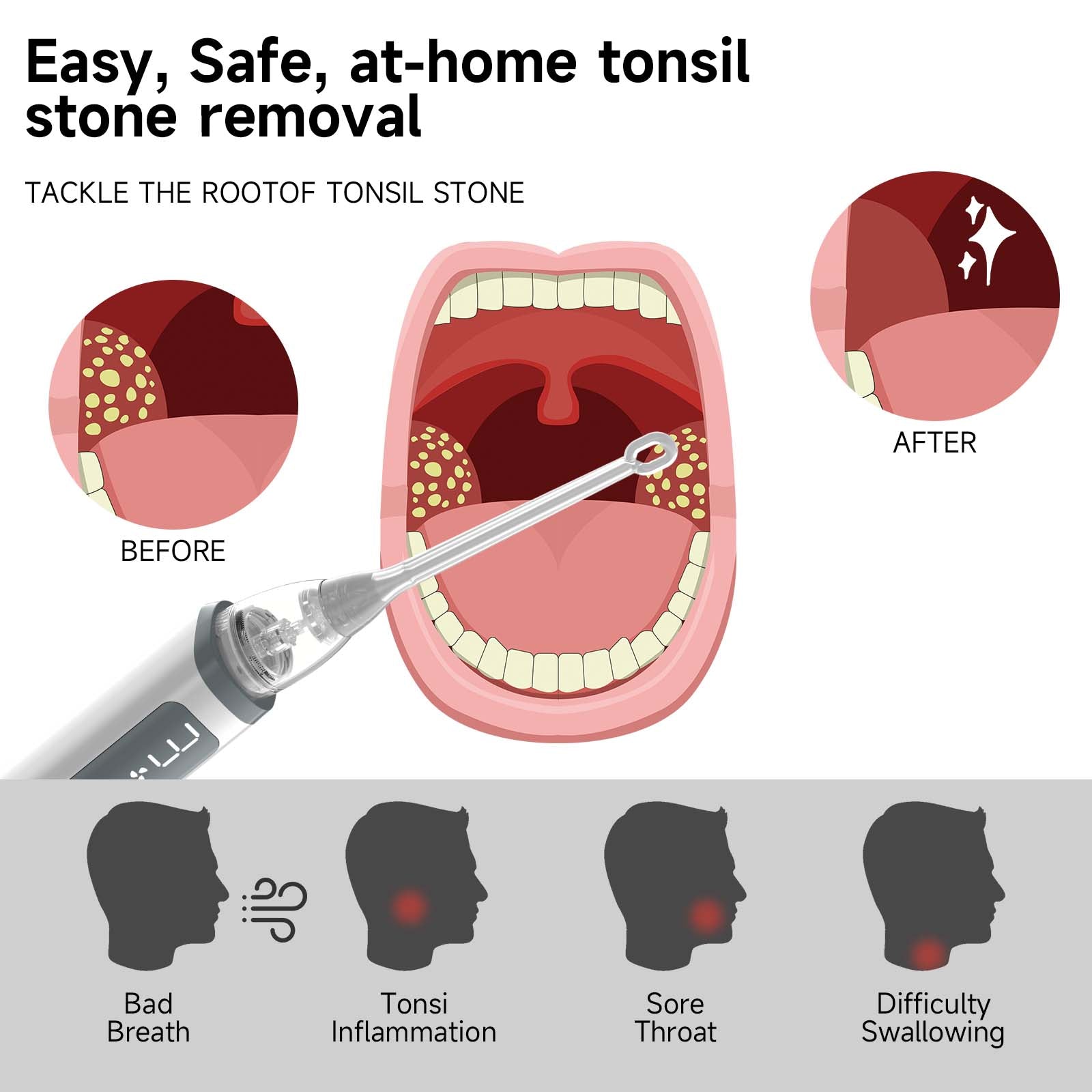 KTS Tonsil Stone Removal Kit with Irrigation Syringe