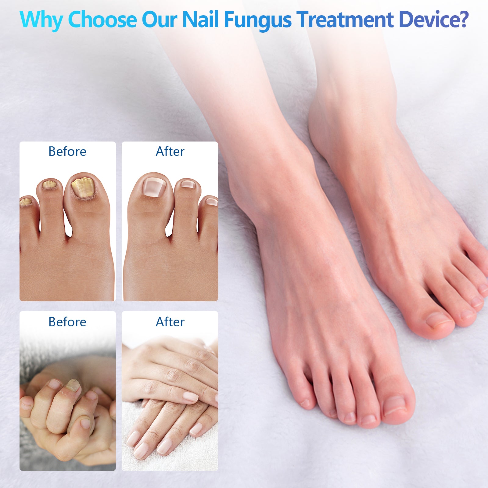 FDA Cleared Portable Laser Therapy Nail Cleaning Device