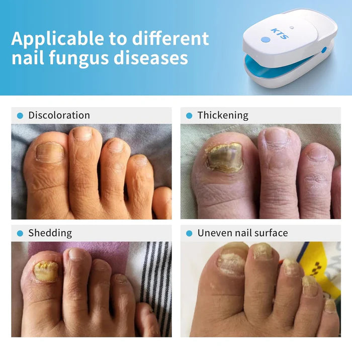 KTS® Nail Fungus Laser Treatment Device Collection