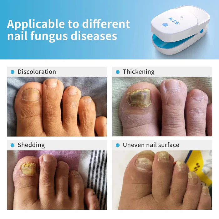 2pics KTS® Nail Fungus Laser Treatment Devices