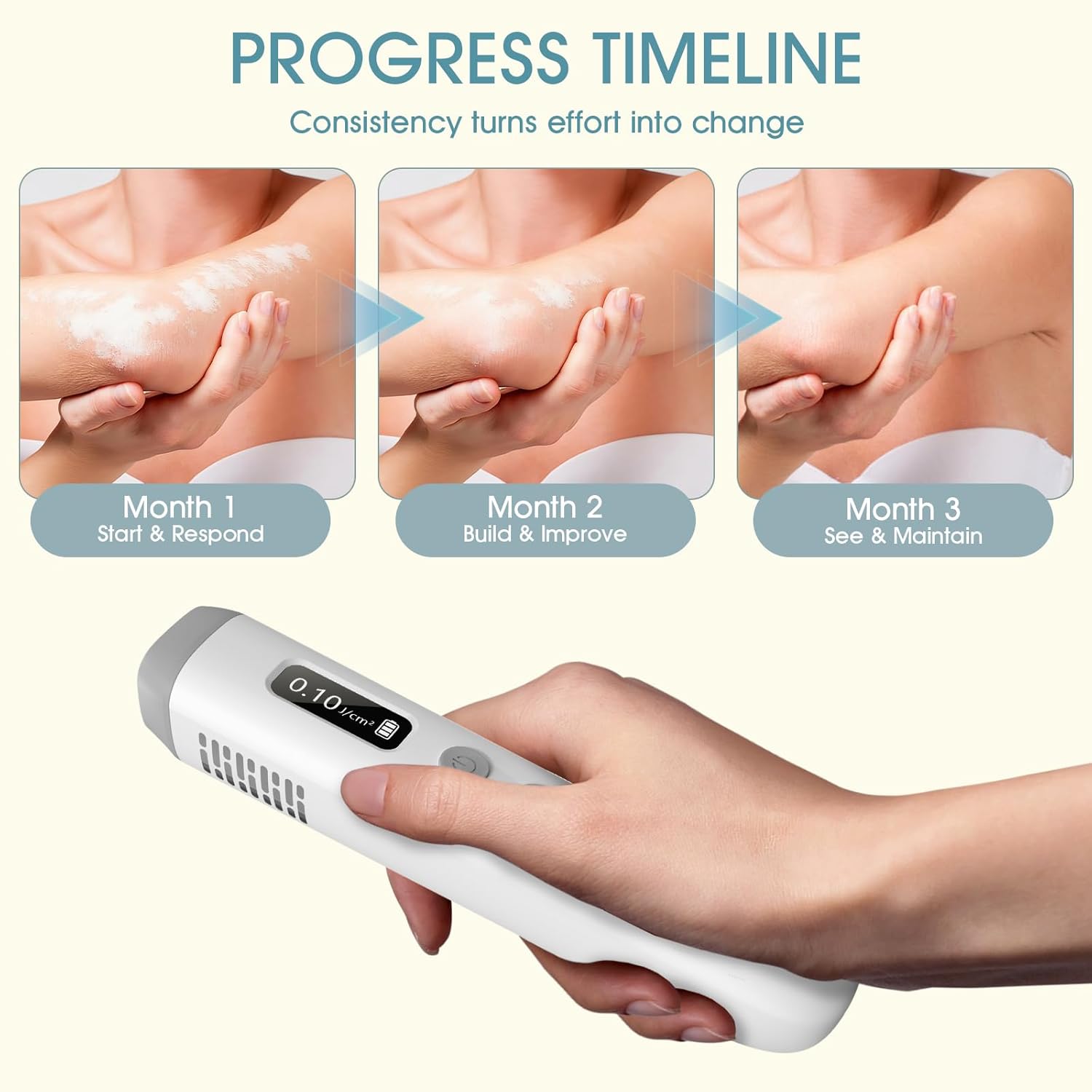 2026 New KTS Handheld 308nm UVB Light Phototherapy Device