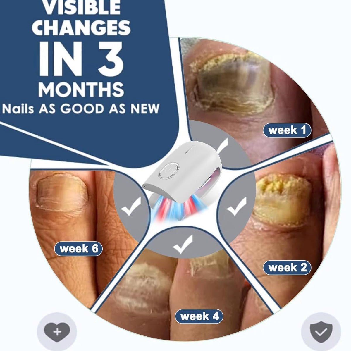 KTS Fungal Nail Treatment Device