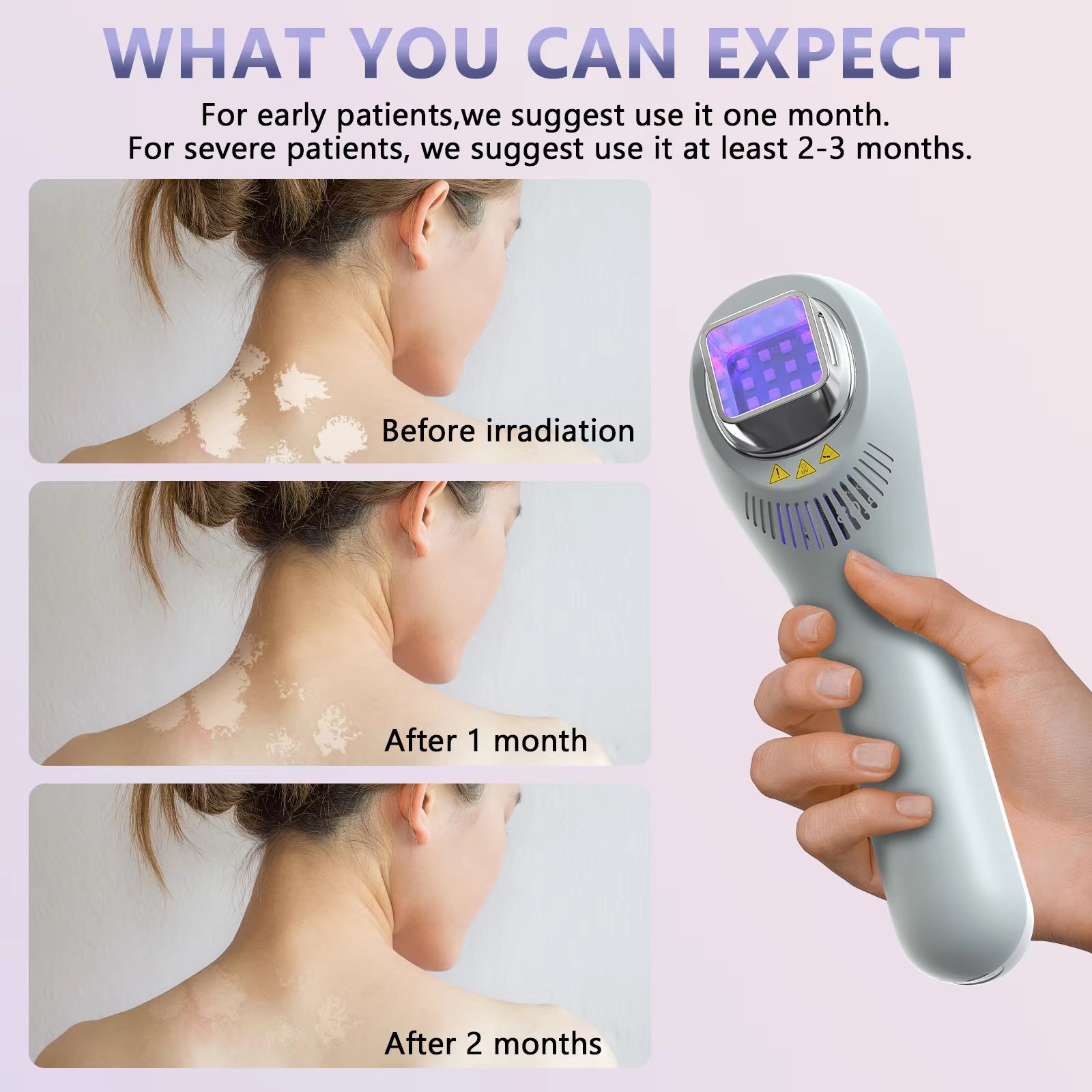 308NM UVB Phototherapy Light on The face, Neck and Limbs